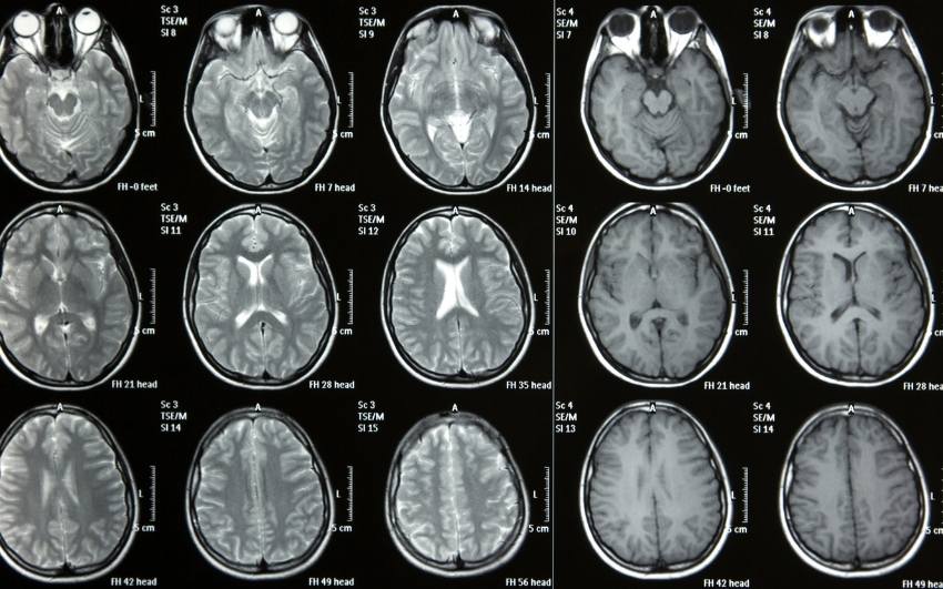 General Human Brain Statistics and Facts